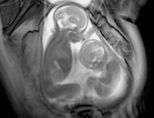 Unborn Twins Caught On Cinematic MRI, Image Credit : Marisa Taylor-Clarke/Imperial College London