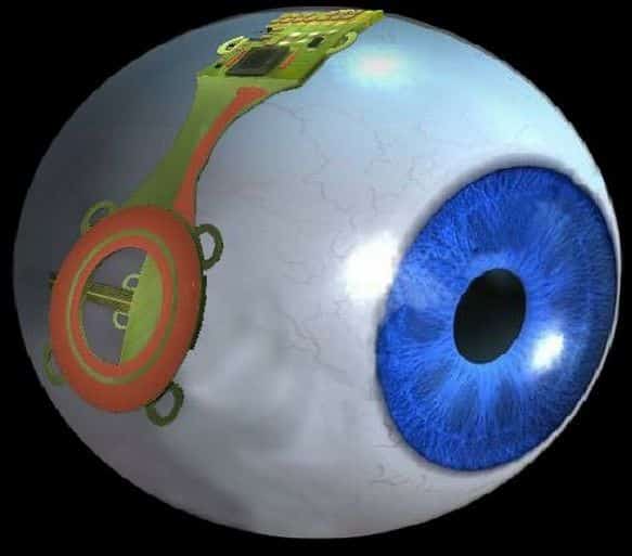 Bionic Eye, Image Credit : urdusky.com