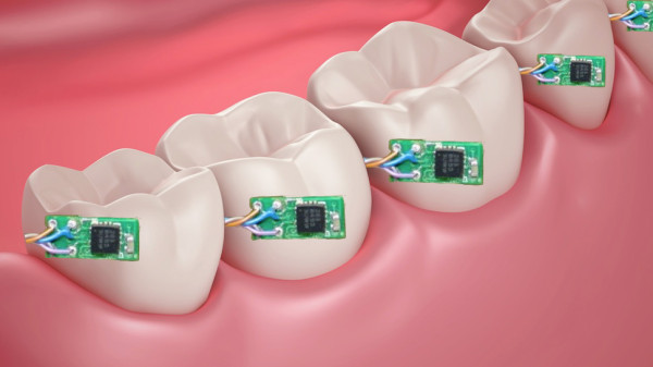 Sensor Embedded On Teeth
