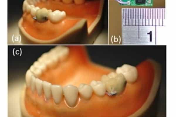 Tooth-embedded Sensor