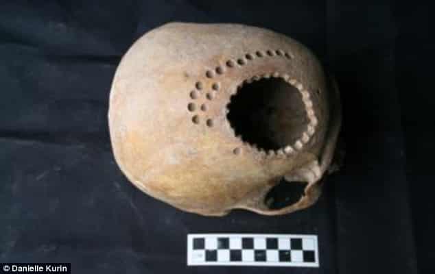 1,000-year-old Skull With Trepanning