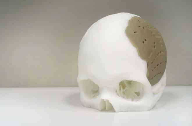 3D Skull implant