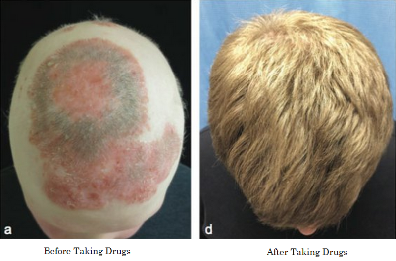 Effect Of Drugs On Bald Head
