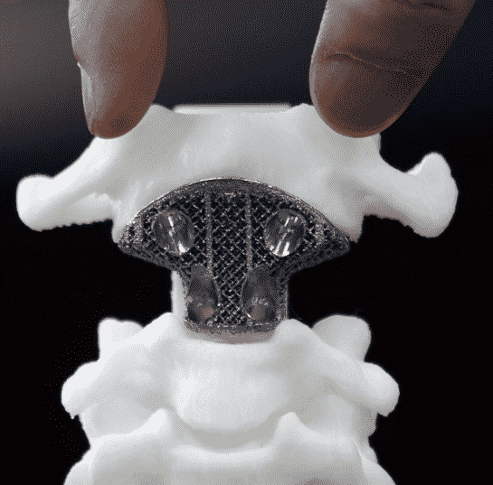 3D-printed Vertebra Inside A Model Spine