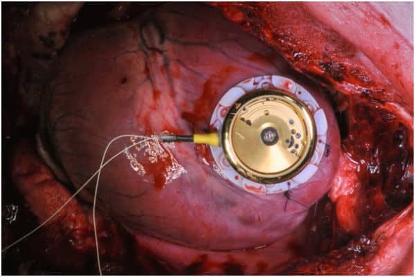 Battery-less pacemaker