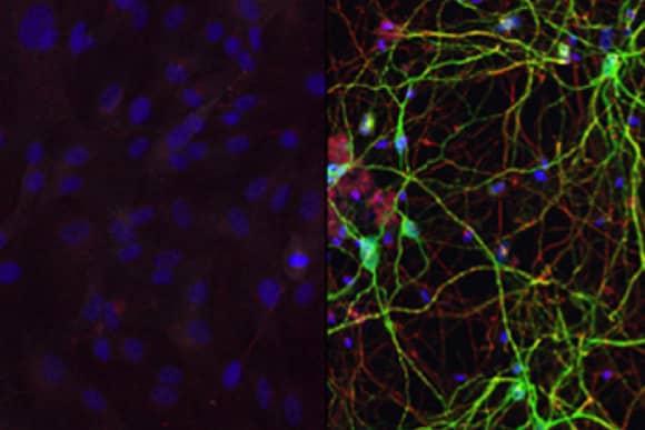Human Skin Cells Converted Into Medium Spiny Neurons