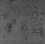 New Breakthrough In Brain Cancer Research