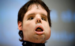 Man Gets A Full Face Transplant For The First Time In History