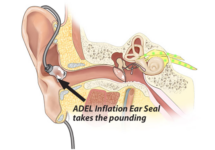 Asius ADEL Ambrose Diaphonic Ear Lens