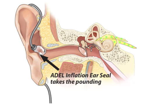 Read more about the article Asius ADEL Ambrose Diaphonic Ear Lens