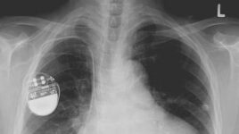 Future Pacemaker Designed To Recharge From Heartbeat Vibrations