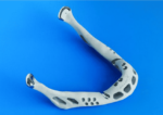 World’s First 3-D Printed Jaw Transplanted To 83 Year Old Woman