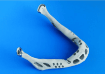 World’s First 3-D Printed Jaw Transplanted To 83 Year Old Woman