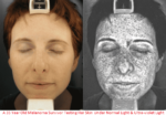 Ultra Violet (UV) Photography Reveals Our Sun Damaged Body Skins