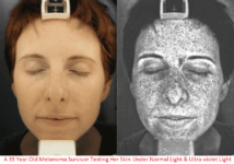 Ultra Violet (UV) Photography Reveals Our Sun Damaged Body Skins