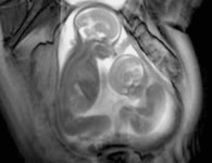 Researchers Captured Unborn Twins Using MRI Technique