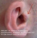 Meet The Man Who Surgically Implanted Earphones In Ear