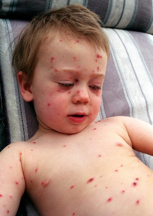 Read more about the article Sudden Outbreak Of Measles Erupts Fifteen Years After Autism Panic