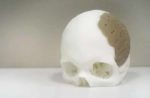 3D Printed Skull Implant Helps Recover Woman’s Sight