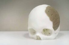 3D Printed Skull Implant Helps Recover Woman’s Sight