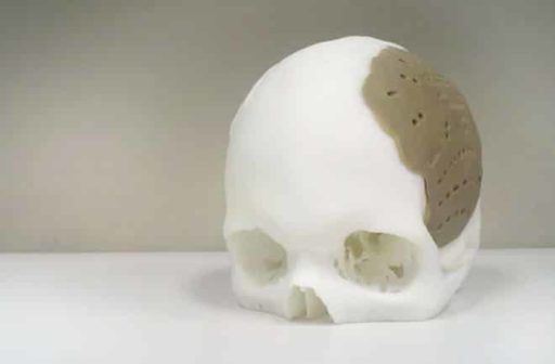 Read more about the article 3D Printed Skull Implant Helps Recover Woman’s Sight