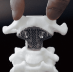 Beijing Hospital Performs World’s First 3D Printed Vertebra Surgery